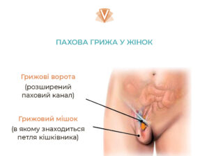 Як визначити наявність пахової грижі у жінок-1