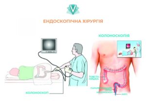 Ознаки наявності пухлини сигмоподібної кишки, методи лікування-1