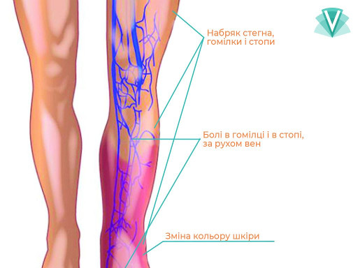 Лікування варикозу-1