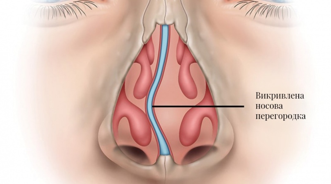 Як зрозуміти, що вам потрібна септопластика: ознаки викривлення носової перегородки-2
