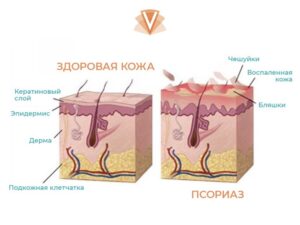 Лечение псориаза-1