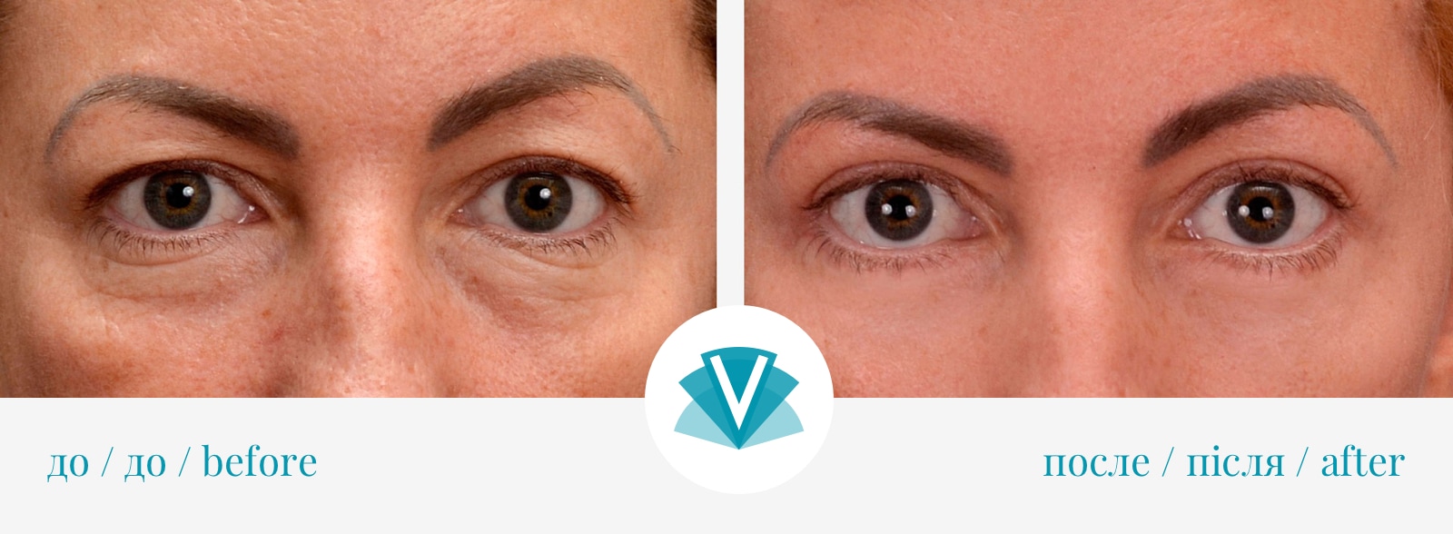 Блефаропластика: види та етапи проведення операції-1