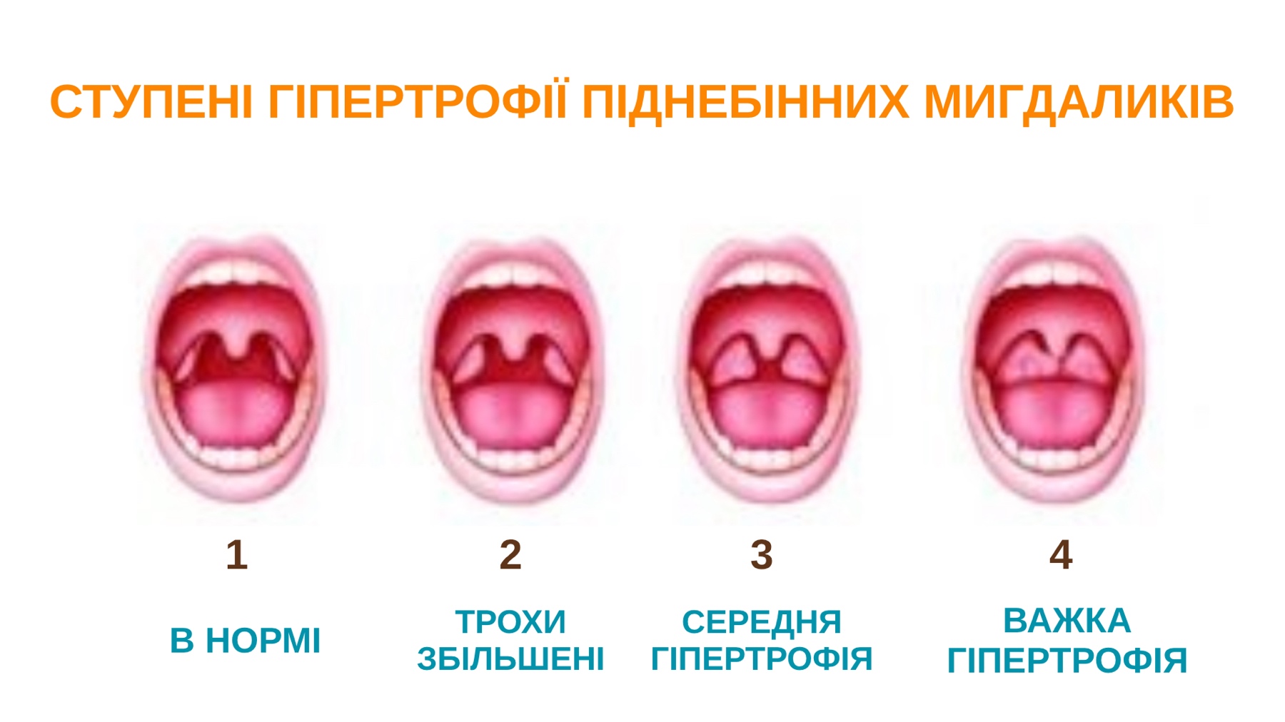 Лікування хронічного тонзиліту (часткове або повне видалення піднебінних мигдаликiв)-1