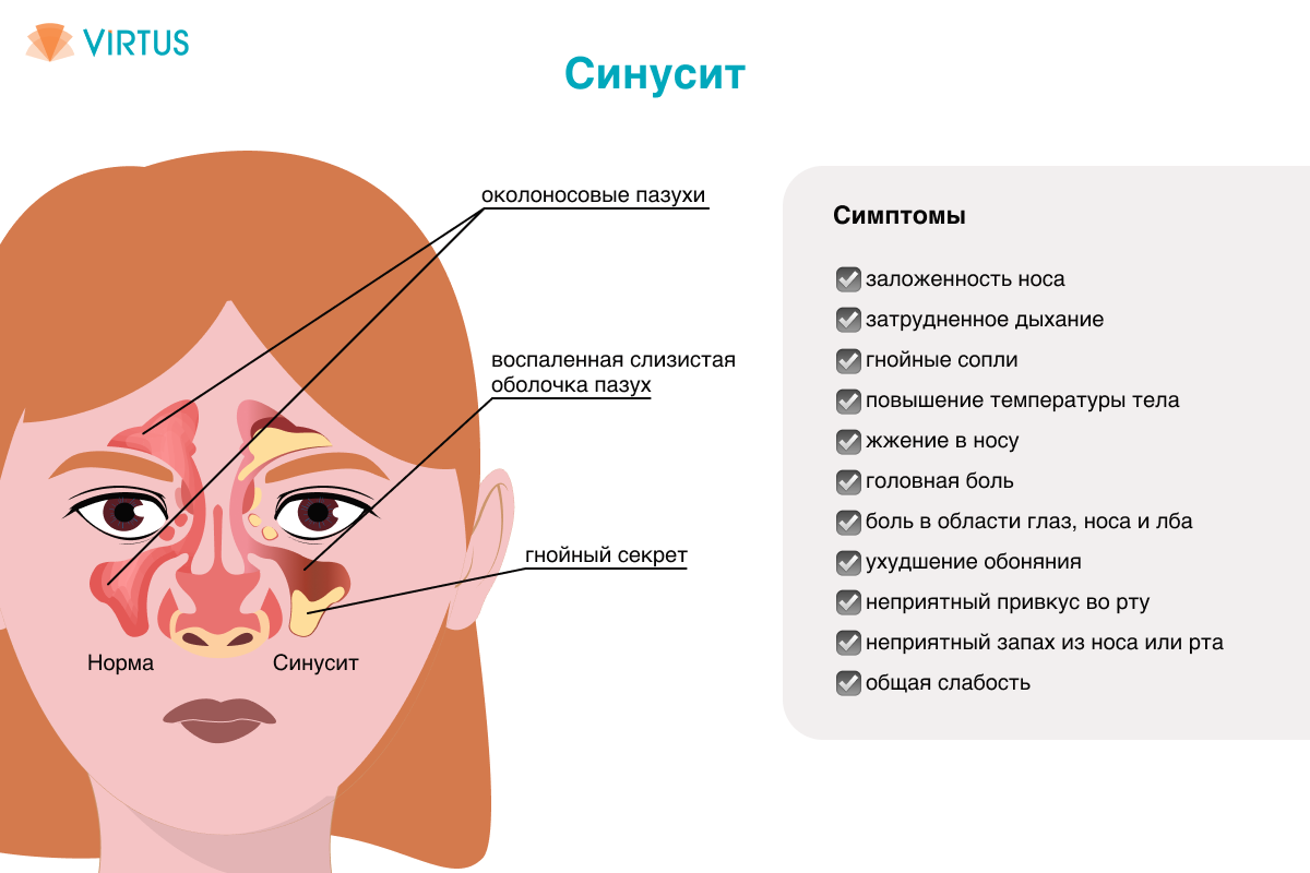 Что такое гайморит и как его лечить?-1