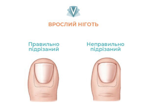 Лікування врослого нігтя-1