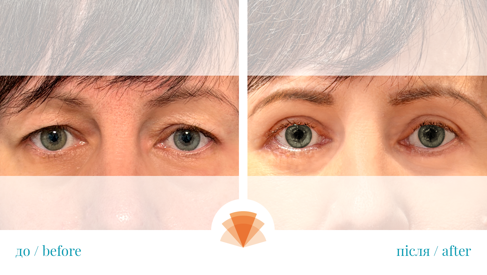 Пластика верхніх та нижніх повік.