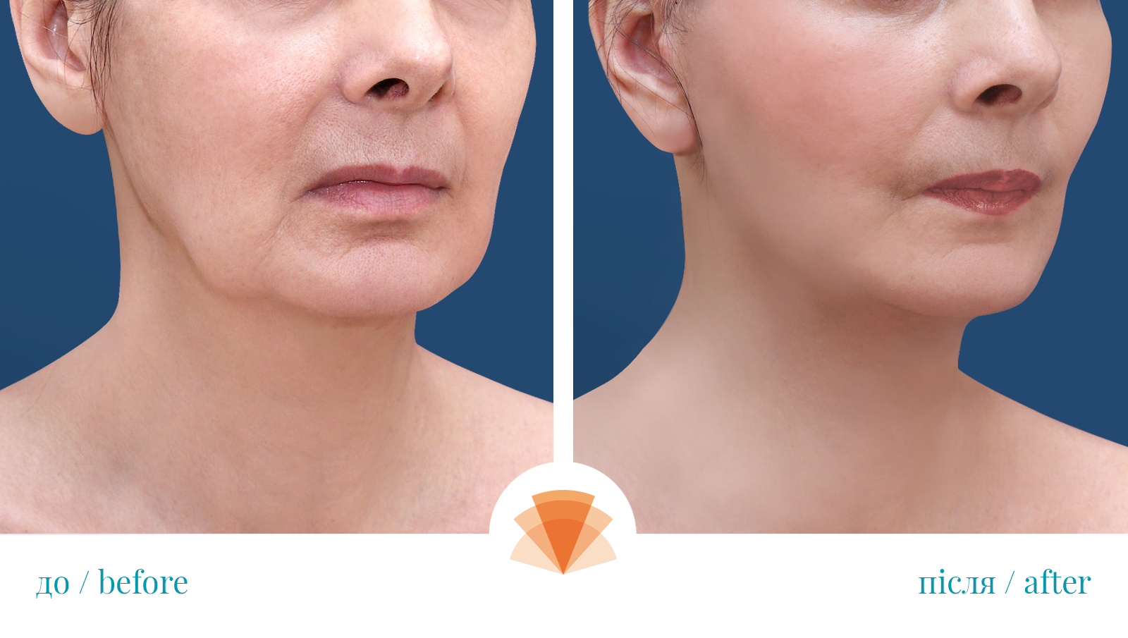 SMAS lifting (face and neck)