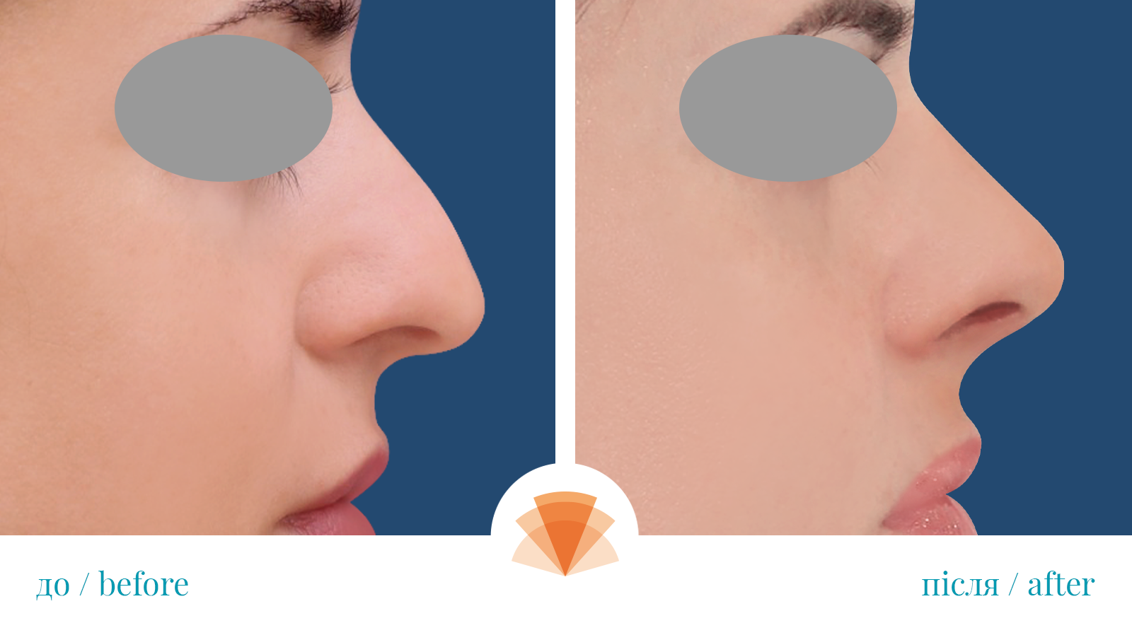 Риносептопластика