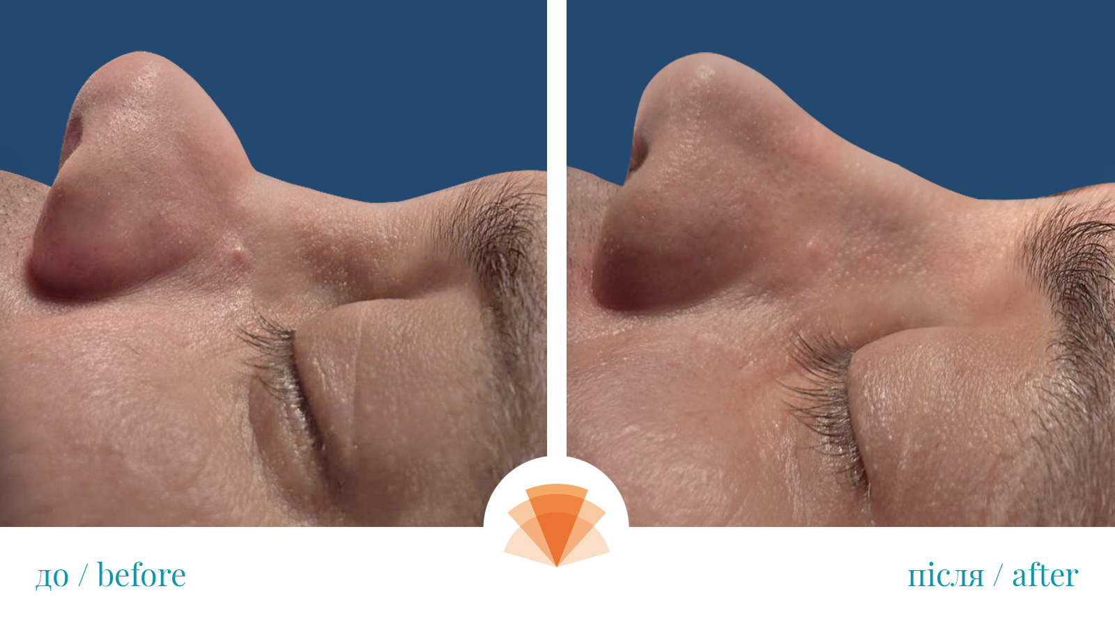 Rhinoplasty (nose plasty)-0