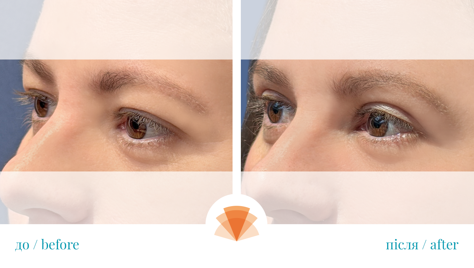 Eyelid surgery under local anesthesia