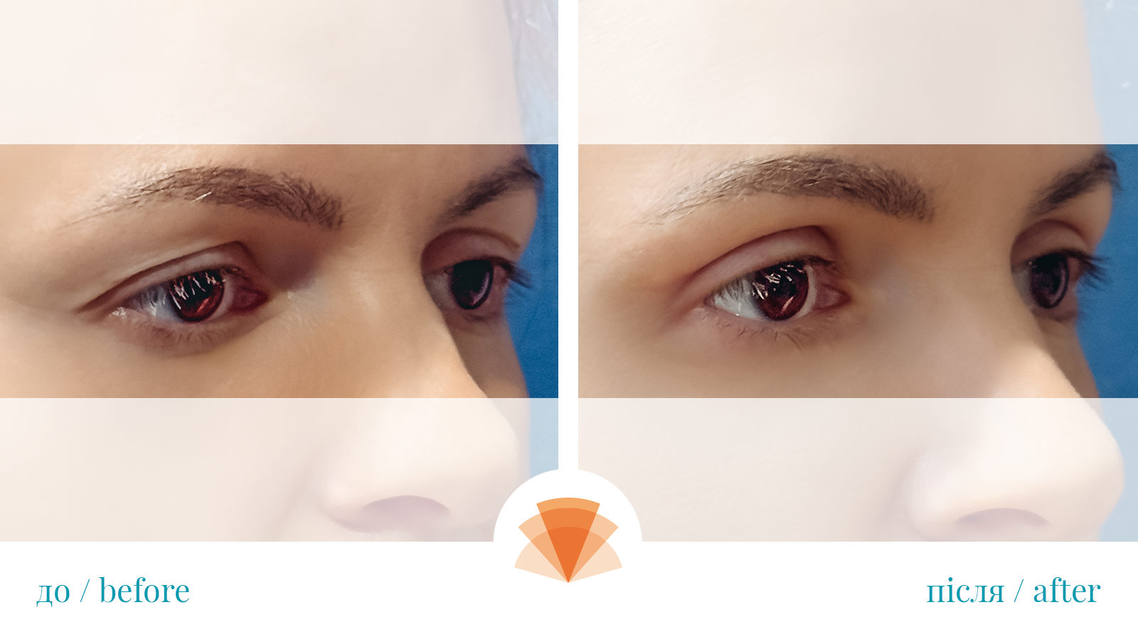 Блефороплавтика под местной анестезией