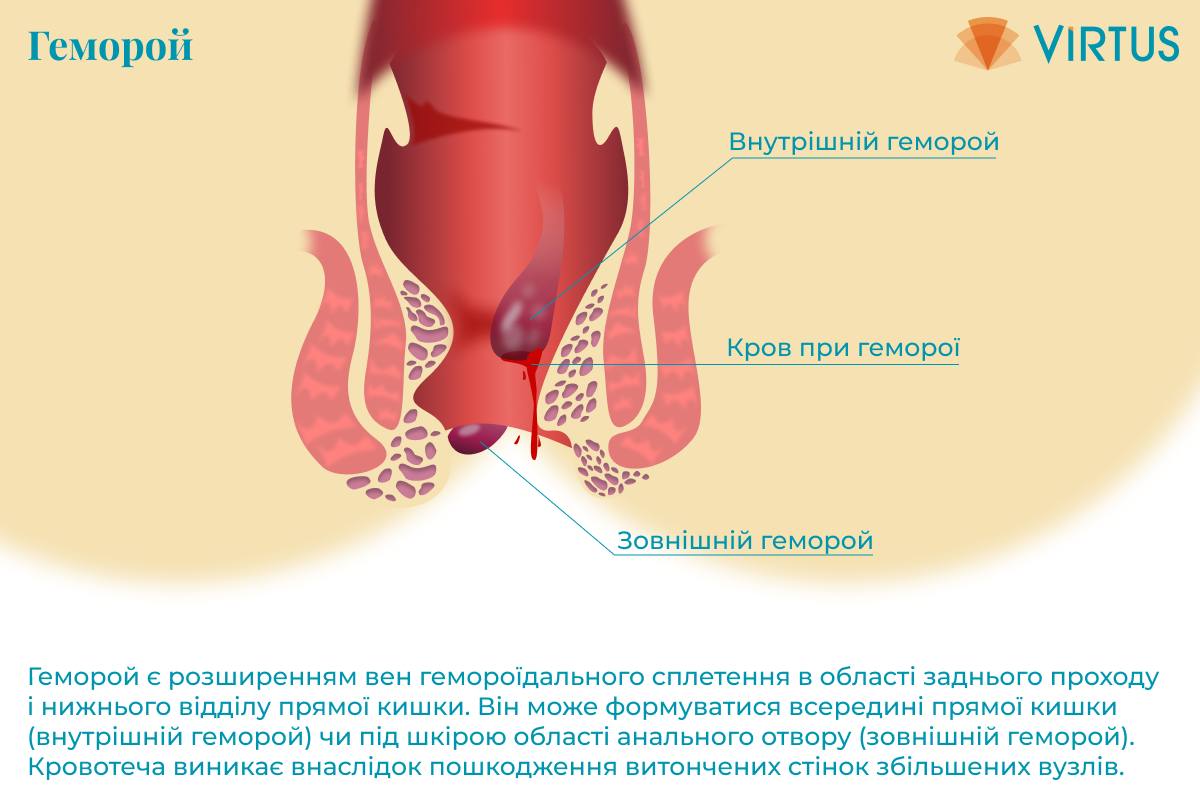 Проктологія-3