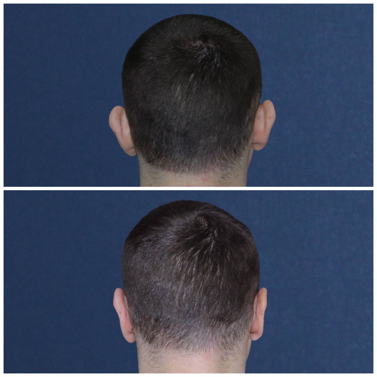 Отопластика (пластика ушей): что нужно знать перед операцией?-1