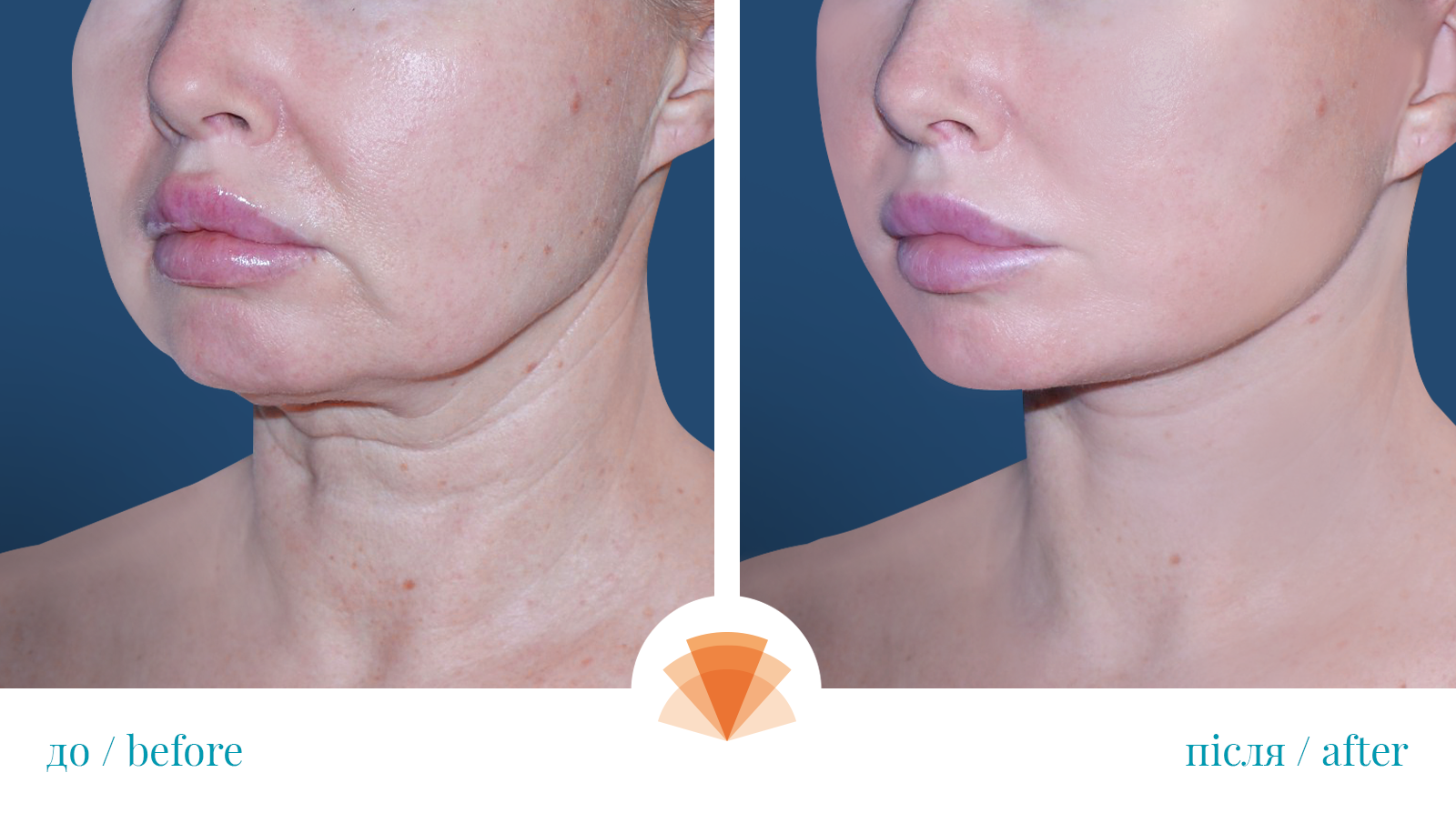 (Українська) DEEP PLANE Омолодження обличчя та шиї